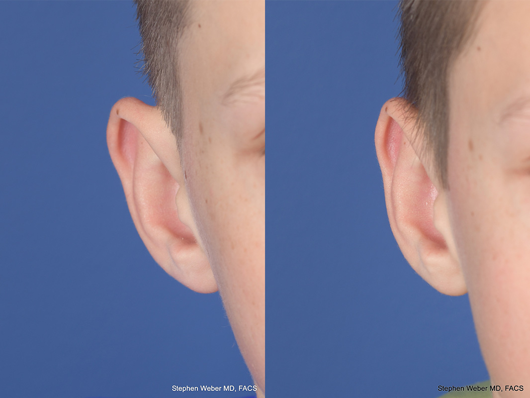 Otoplasty Before and After | Weber Facial Plastic Surgery