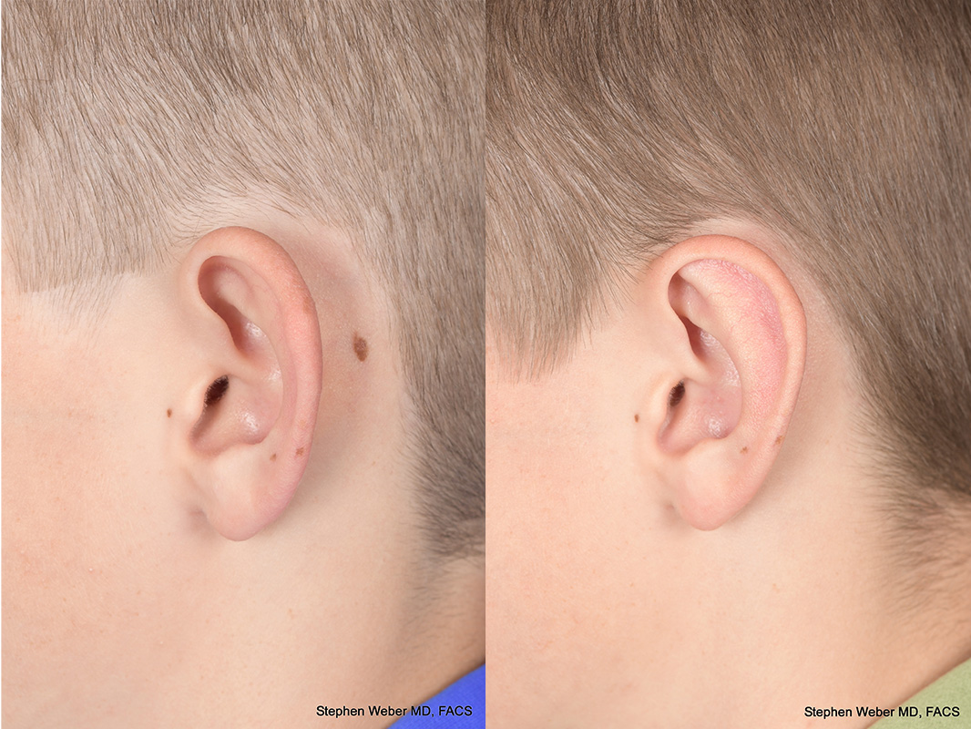Otoplasty Before and After | Weber Facial Plastic Surgery
