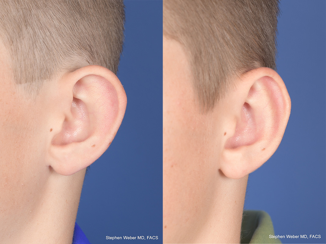Otoplasty Before and After | Weber Facial Plastic Surgery
