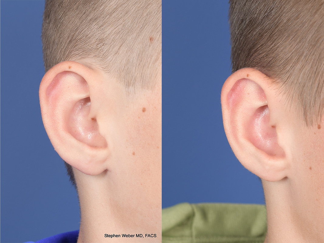 Otoplasty Before and After | Weber Facial Plastic Surgery
