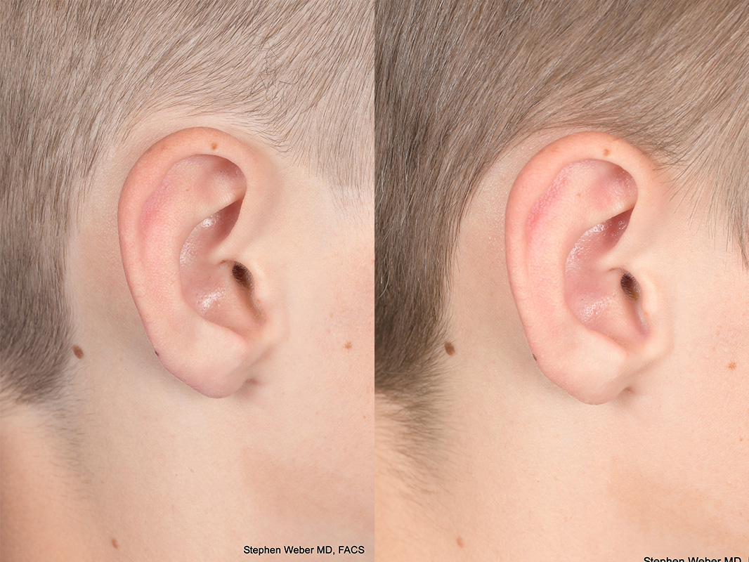 Otoplasty Before and After | Weber Facial Plastic Surgery