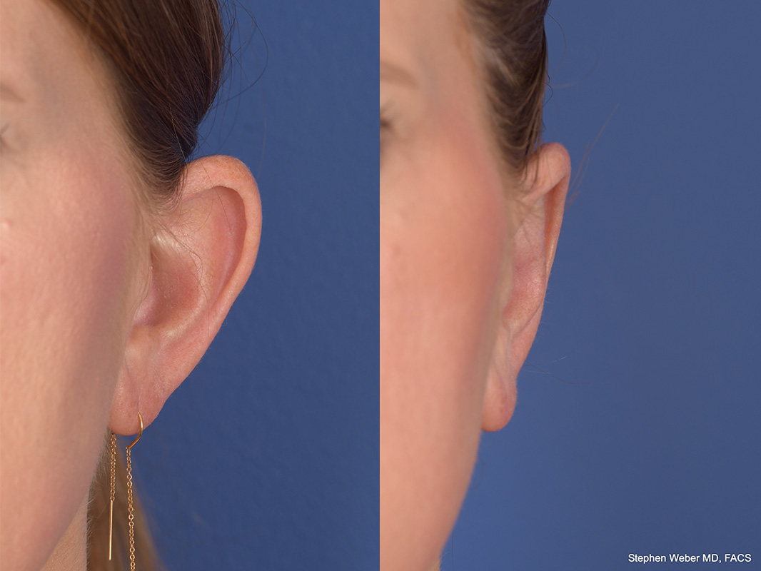 Otoplasty Before and After | Weber Facial Plastic Surgery
