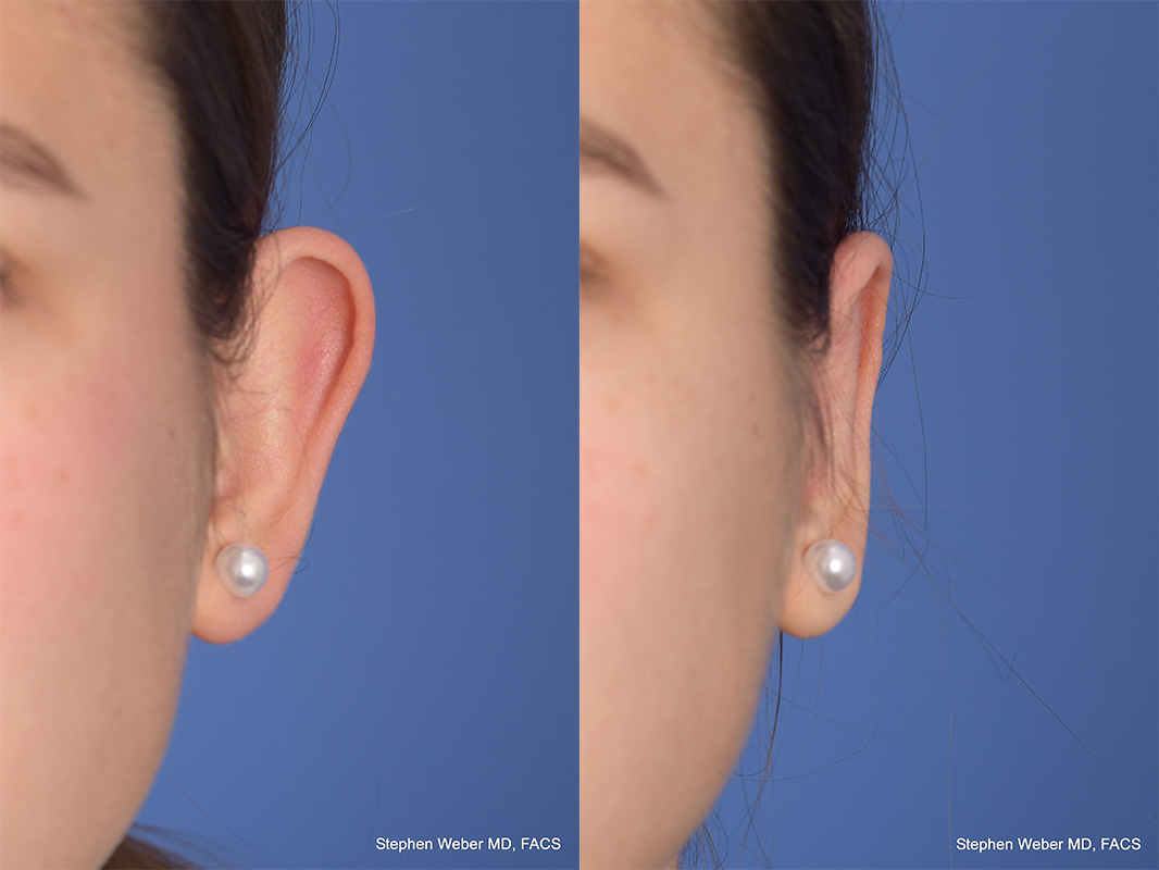 Otoplasty Before and After | Weber Facial Plastic Surgery