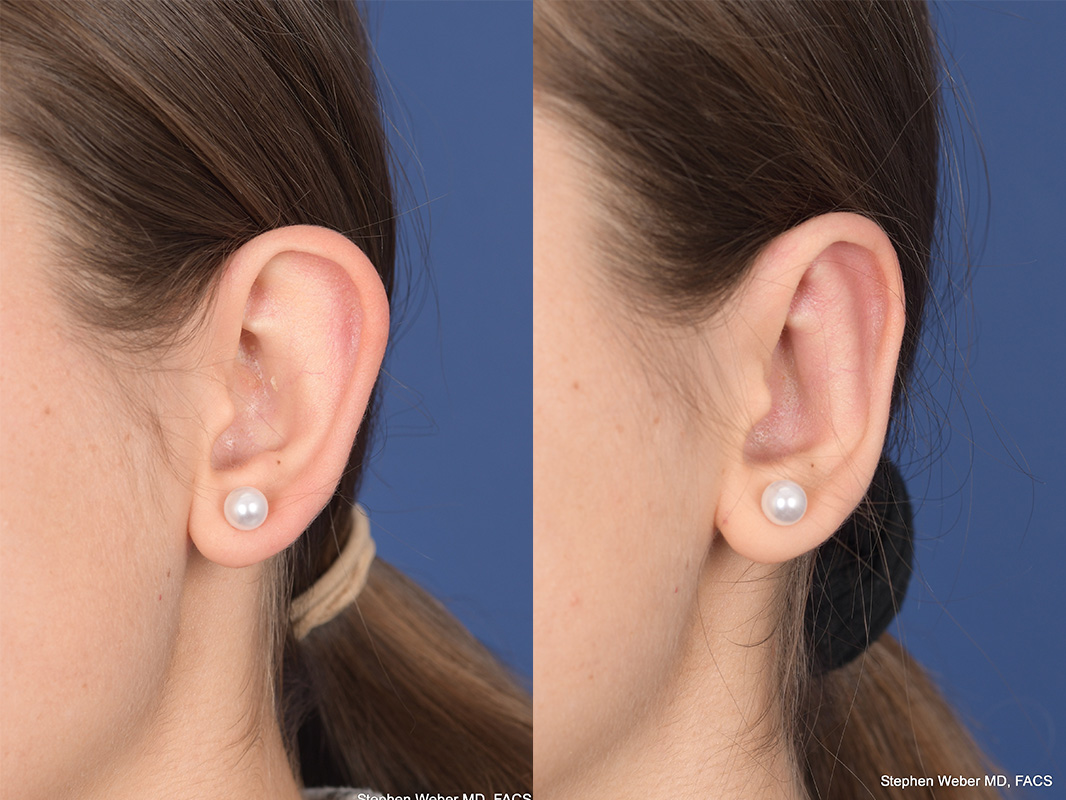 Otoplasty Before and After | Weber Facial Plastic Surgery