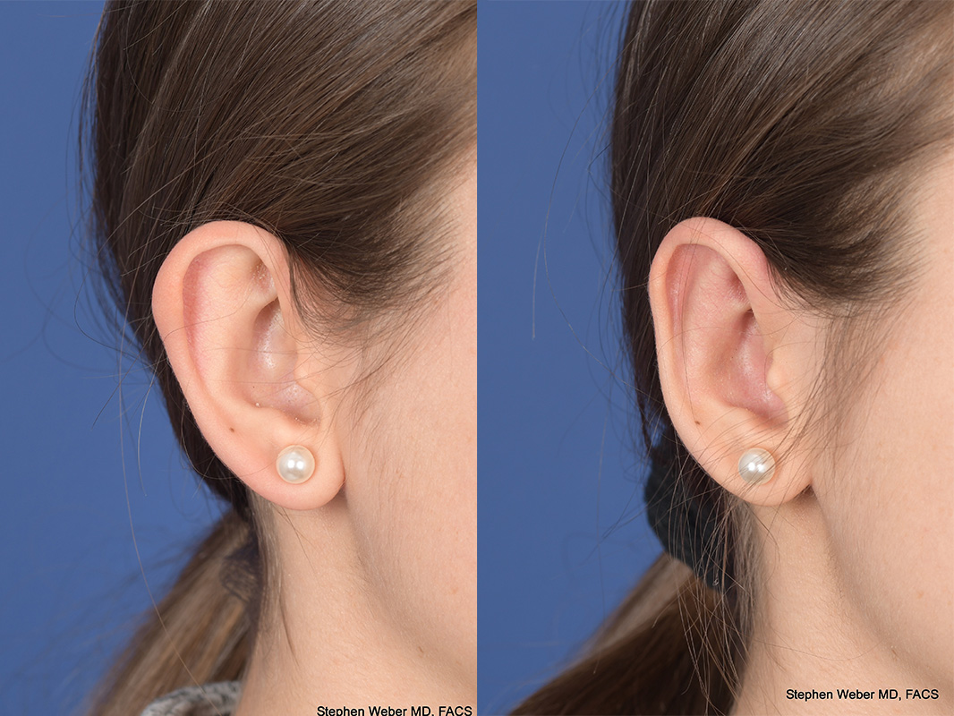 Otoplasty Before and After | Weber Facial Plastic Surgery