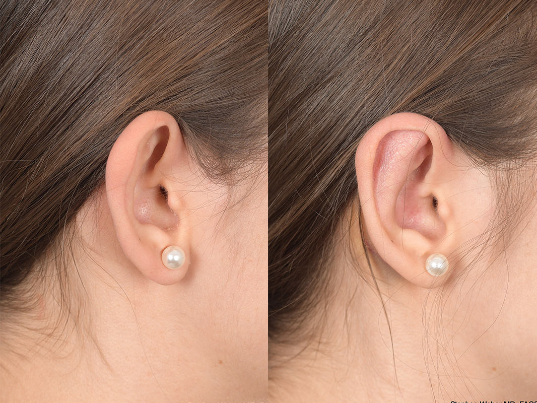 Otoplasty Before and After | Weber Facial Plastic Surgery