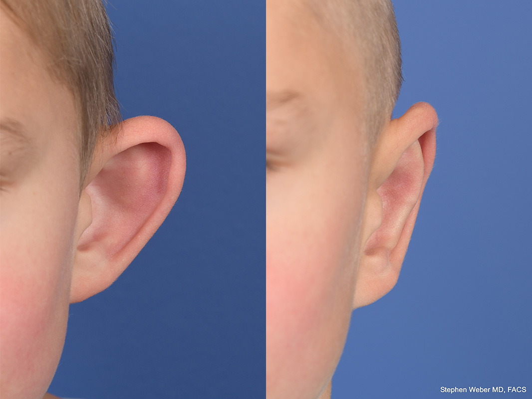 Otoplasty Before and After | Weber Facial Plastic Surgery