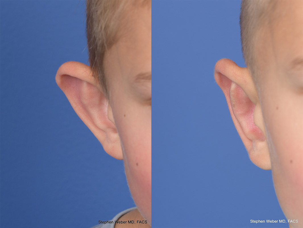 Otoplasty Before and After | Weber Facial Plastic Surgery