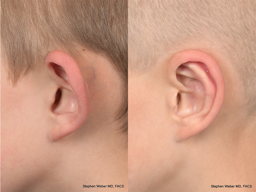 Otoplasty Before and After | Weber Facial Plastic Surgery
