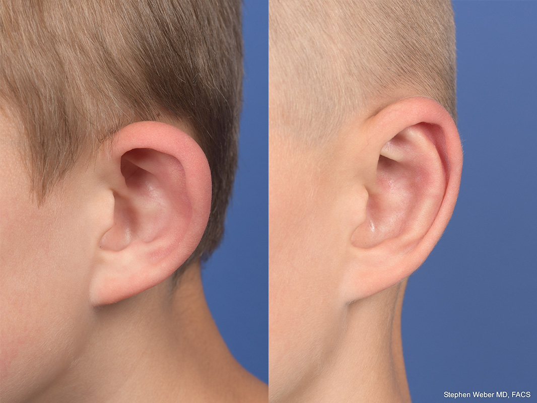 Otoplasty Before and After | Weber Facial Plastic Surgery
