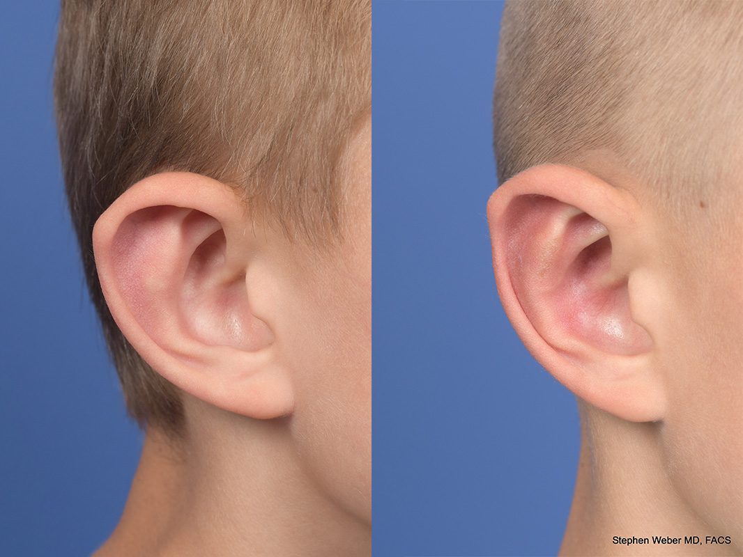 Otoplasty Before and After | Weber Facial Plastic Surgery