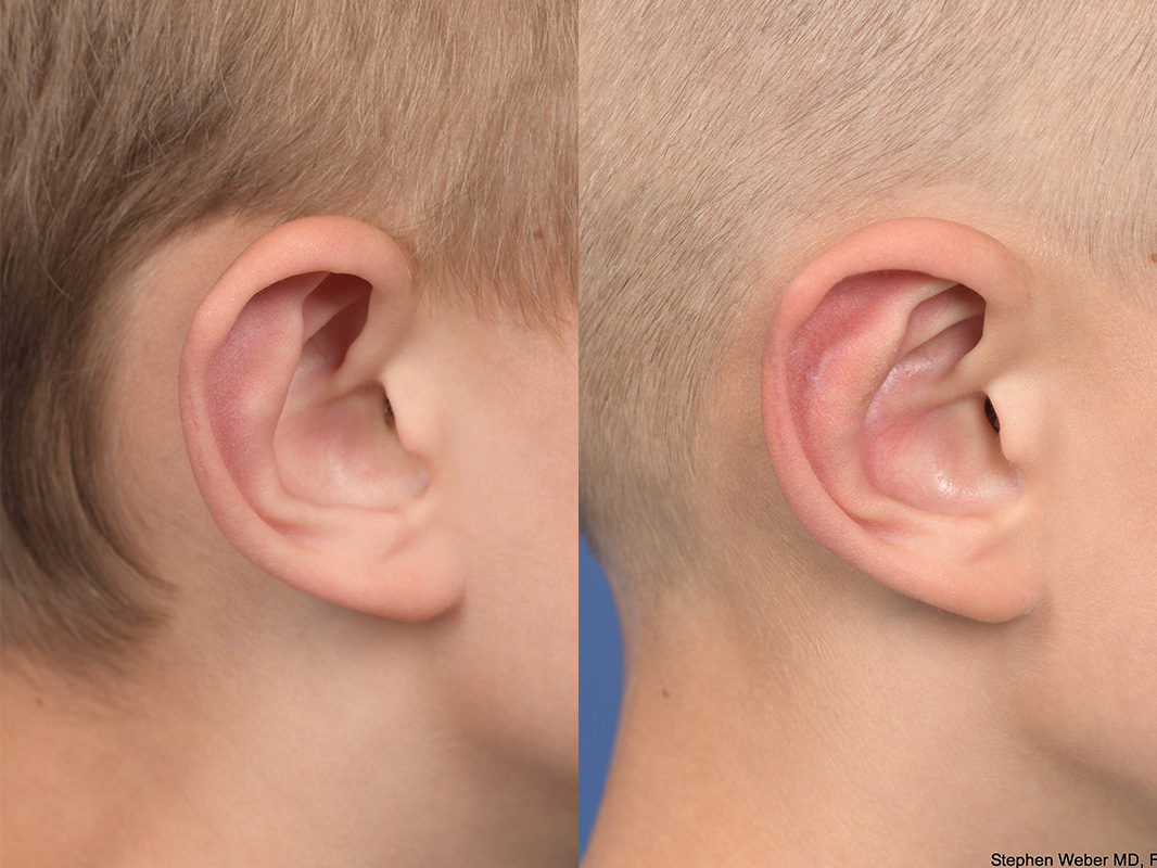 Otoplasty Before and After | Weber Facial Plastic Surgery