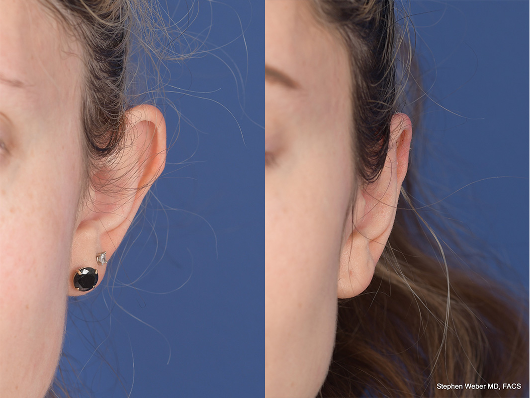 Otoplasty Before and After | Weber Facial Plastic Surgery
