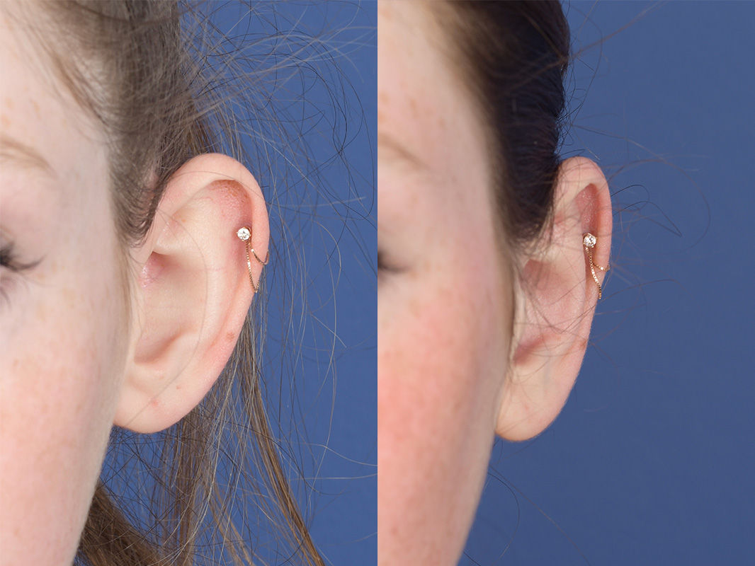 Otoplasty Before and After | Weber Facial Plastic Surgery