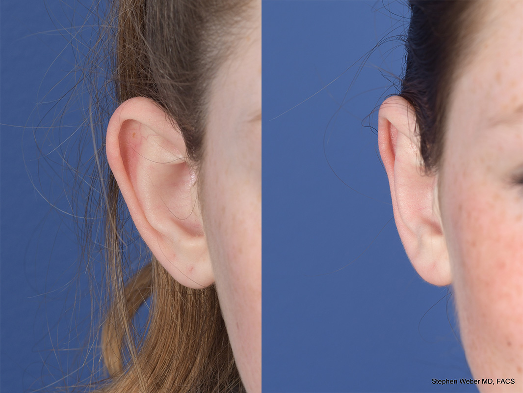Otoplasty Before and After | Weber Facial Plastic Surgery