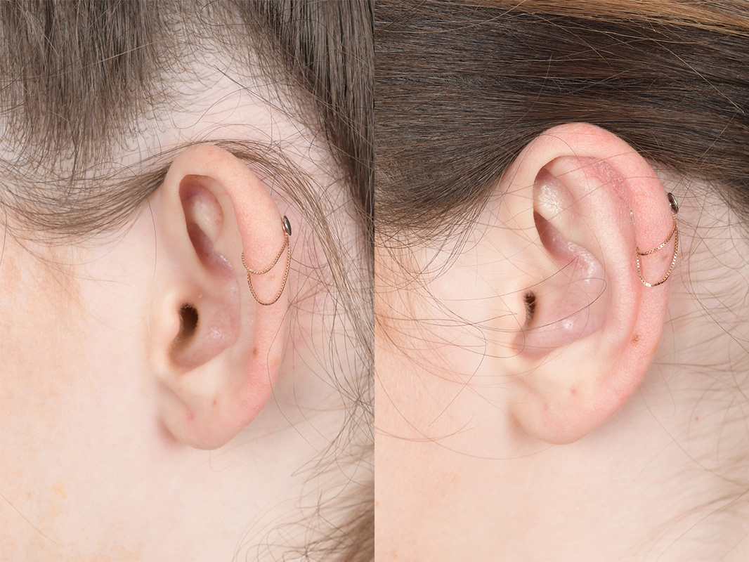 Otoplasty Before and After | Weber Facial Plastic Surgery