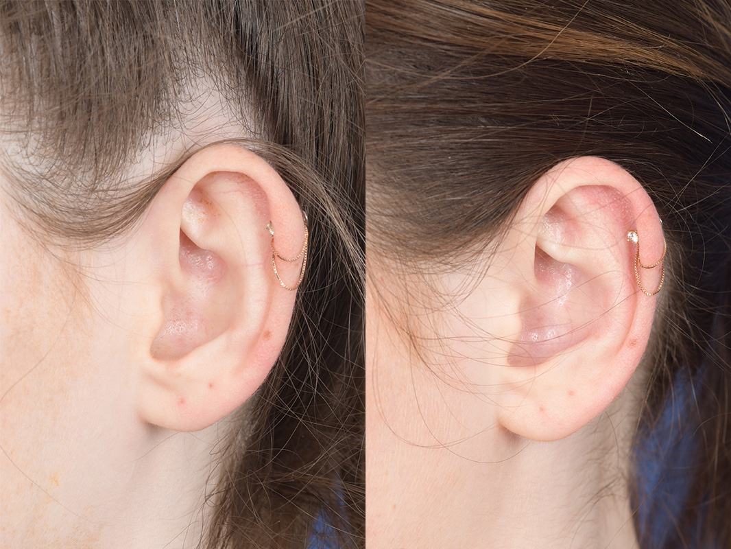 Otoplasty Before and After | Weber Facial Plastic Surgery