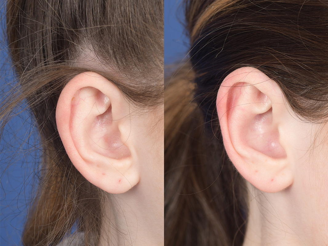 Otoplasty Before and After | Weber Facial Plastic Surgery