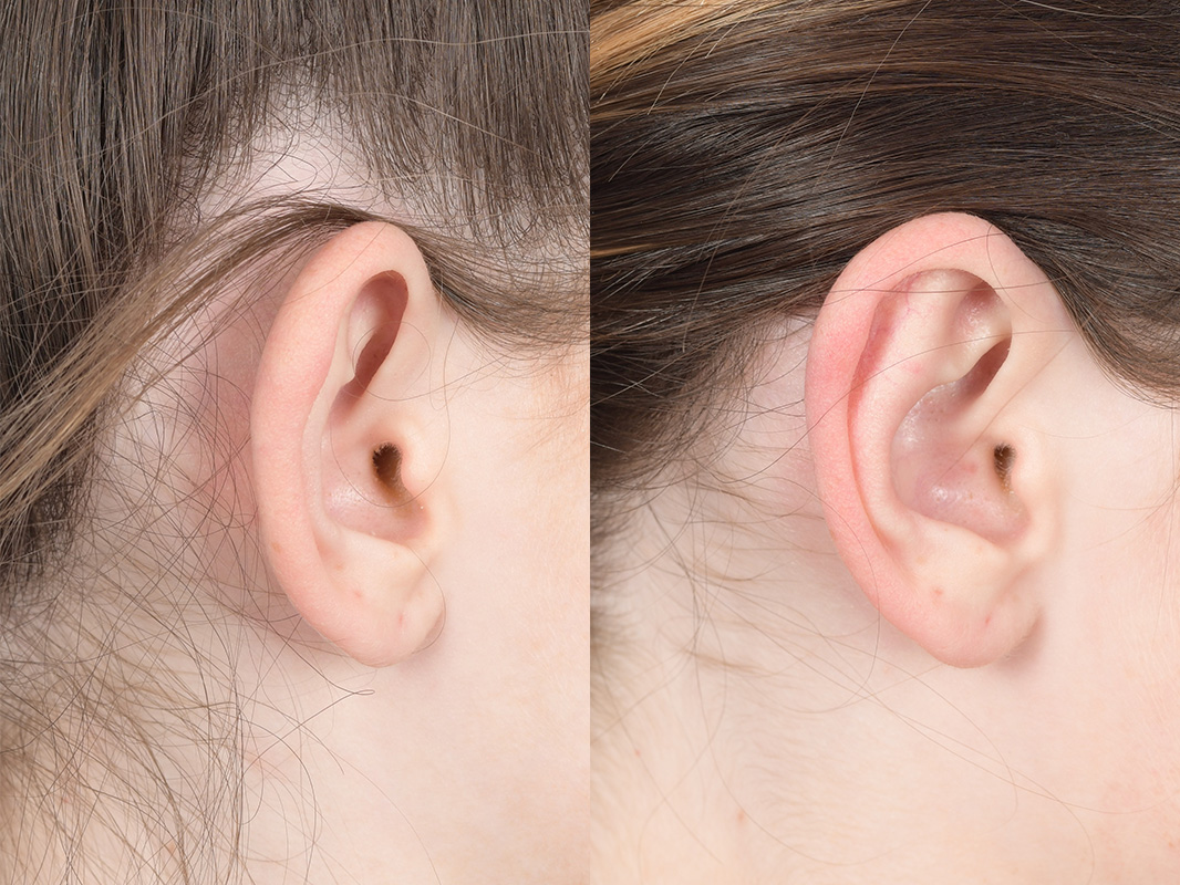 Otoplasty Before and After | Weber Facial Plastic Surgery