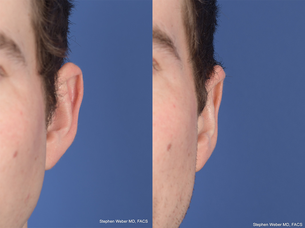 Otoplasty Before and After | Weber Facial Plastic Surgery