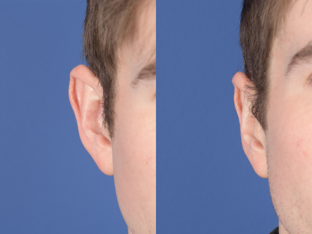 Otoplasty Before and After | Weber Facial Plastic Surgery