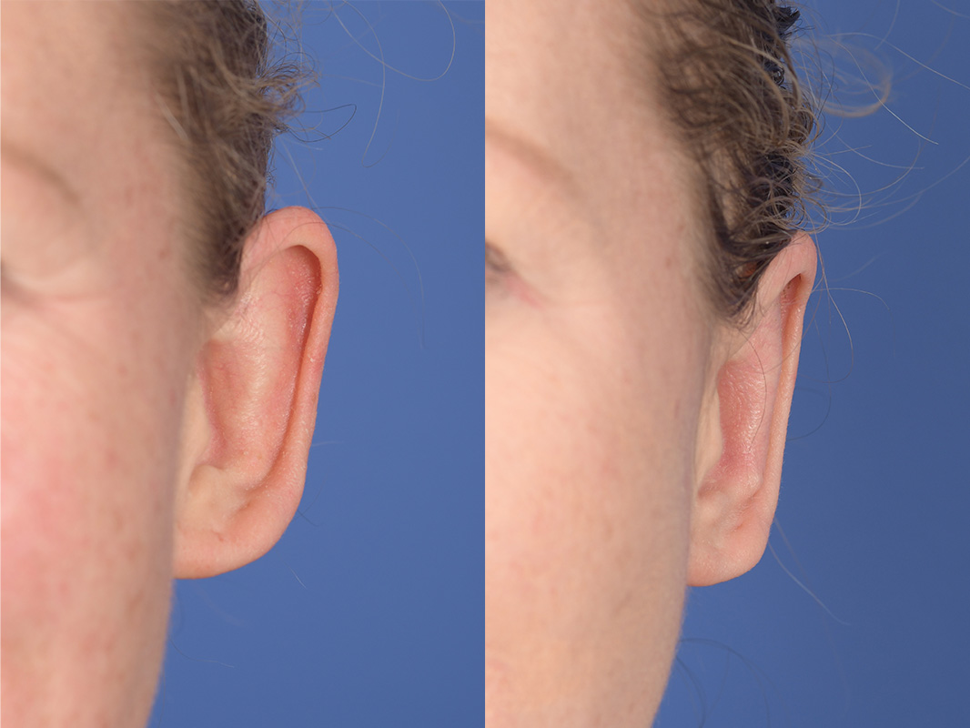 Otoplasty Before and After | Weber Facial Plastic Surgery