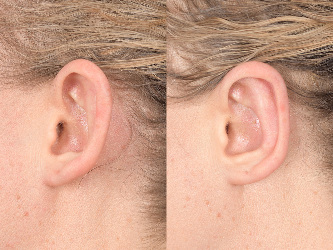 Otoplasty Before and After | Weber Facial Plastic Surgery