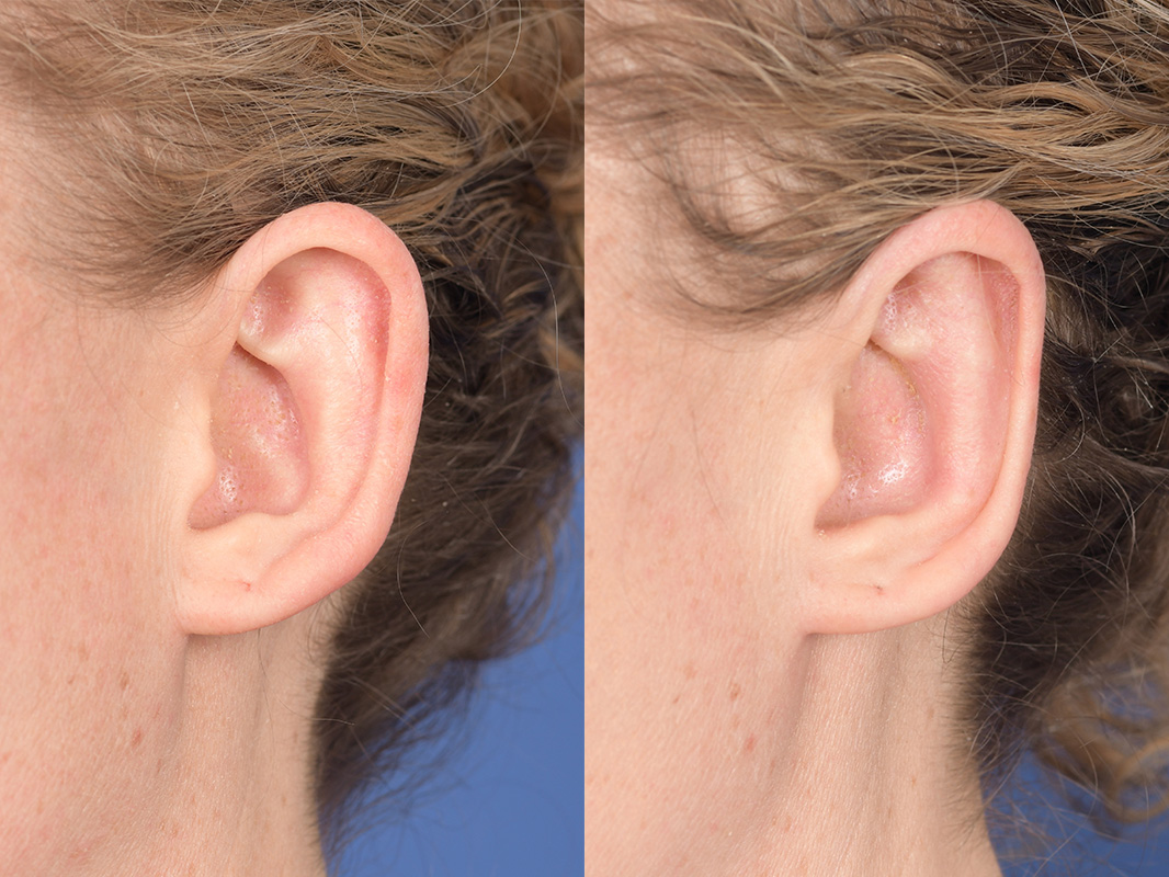Otoplasty Before and After | Weber Facial Plastic Surgery