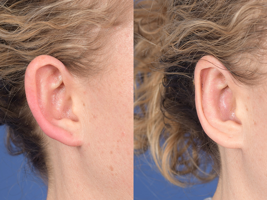 Otoplasty Before and After | Weber Facial Plastic Surgery