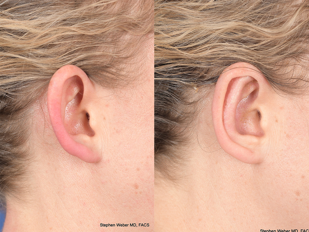 Otoplasty Before and After | Weber Facial Plastic Surgery
