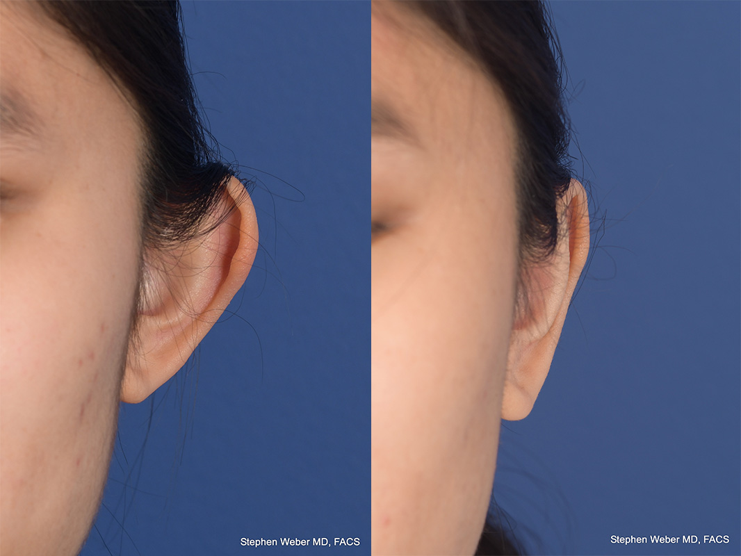 Otoplasty Before and After | Weber Facial Plastic Surgery