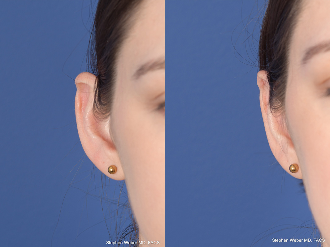 Otoplasty Before and After | Weber Facial Plastic Surgery