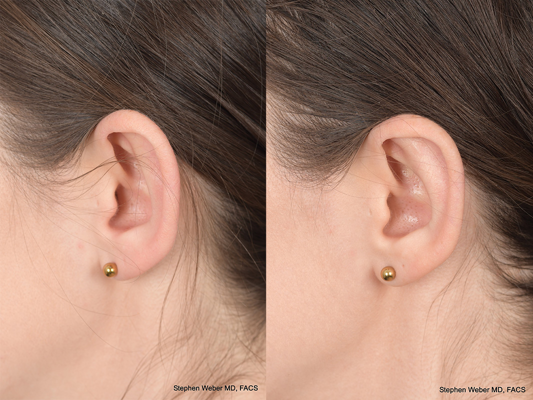 Otoplasty Before and After | Weber Facial Plastic Surgery