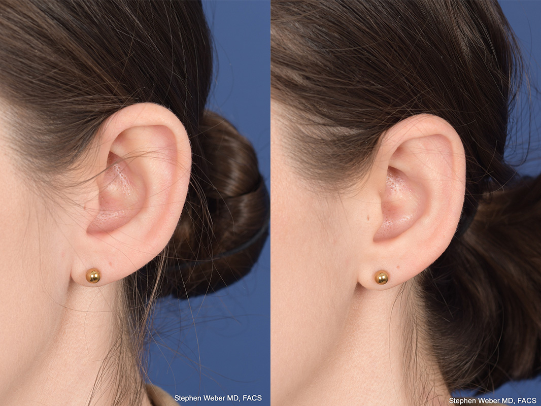 Otoplasty Before and After | Weber Facial Plastic Surgery