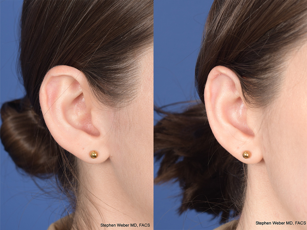 Otoplasty Before and After | Weber Facial Plastic Surgery