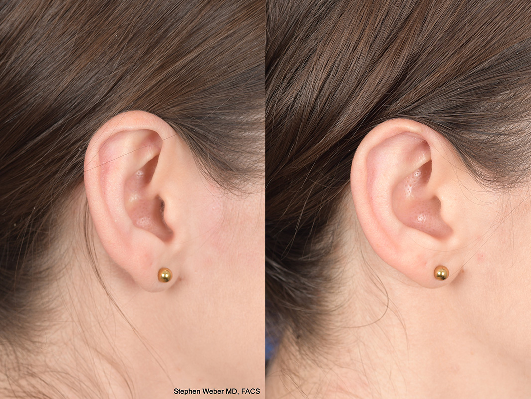 Otoplasty Before and After | Weber Facial Plastic Surgery