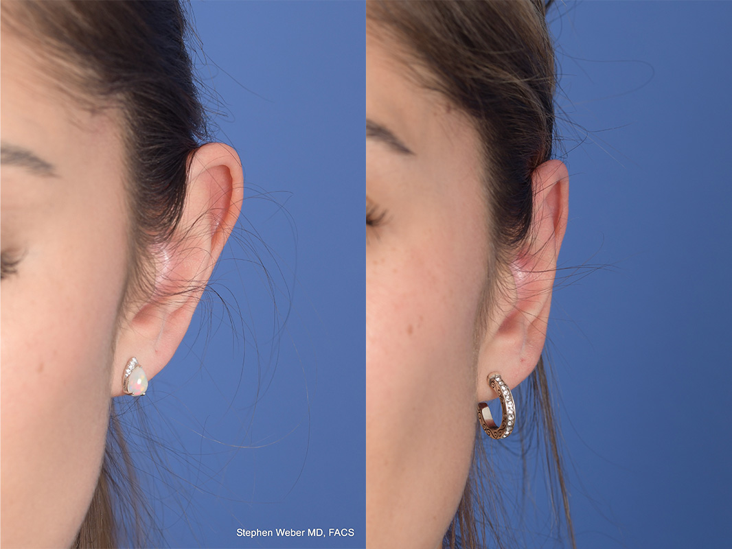 Otoplasty Before and After | Weber Facial Plastic Surgery