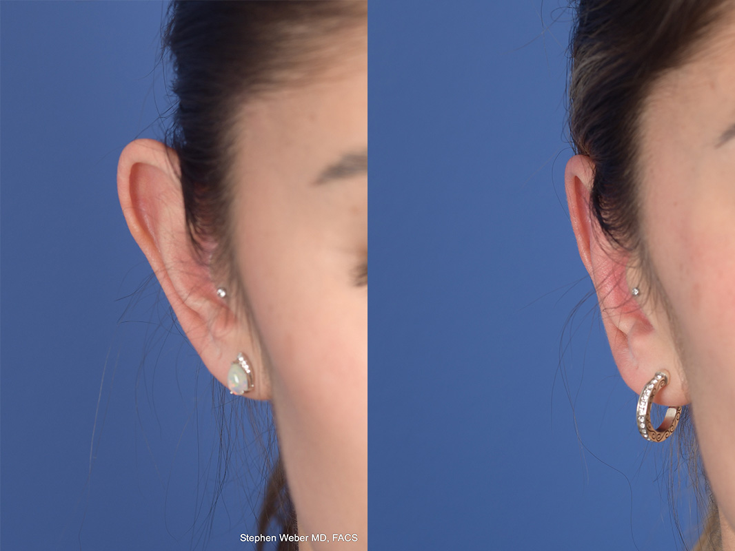 Otoplasty Before and After | Weber Facial Plastic Surgery