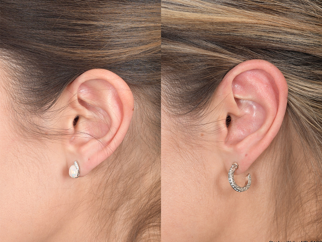 Otoplasty Before and After | Weber Facial Plastic Surgery