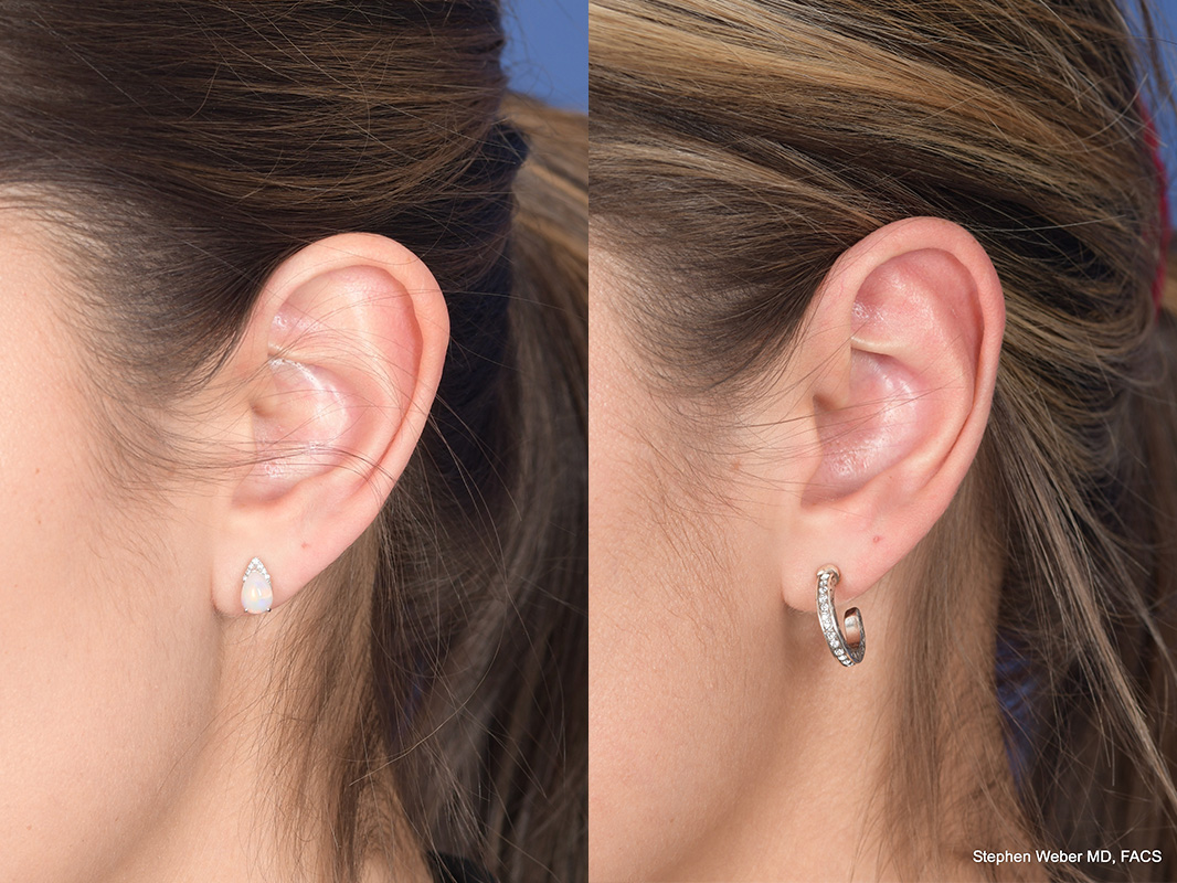 Otoplasty Before and After | Weber Facial Plastic Surgery