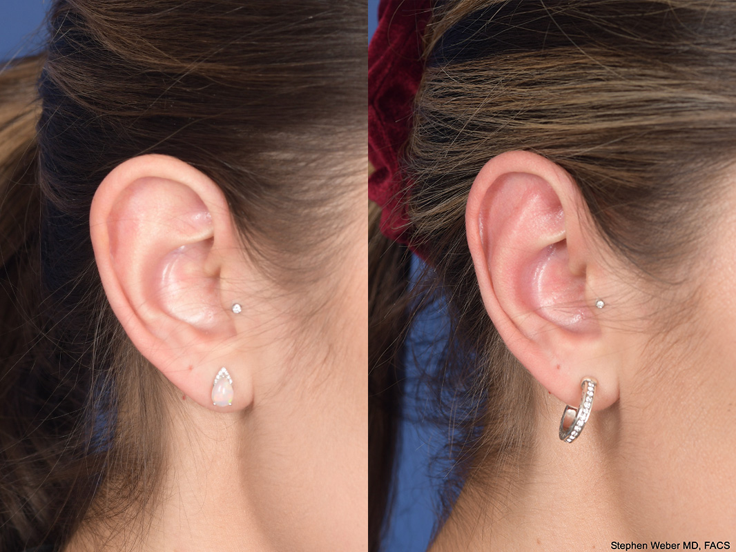 Otoplasty Before and After | Weber Facial Plastic Surgery