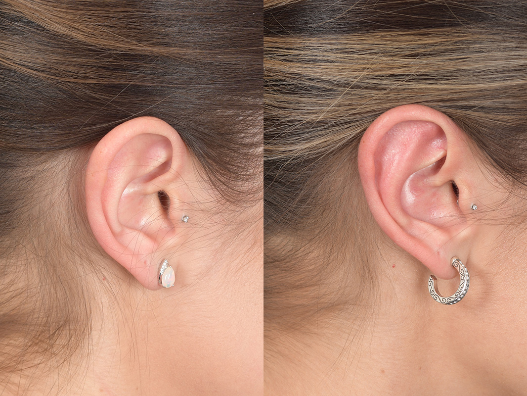 Otoplasty Before and After | Weber Facial Plastic Surgery