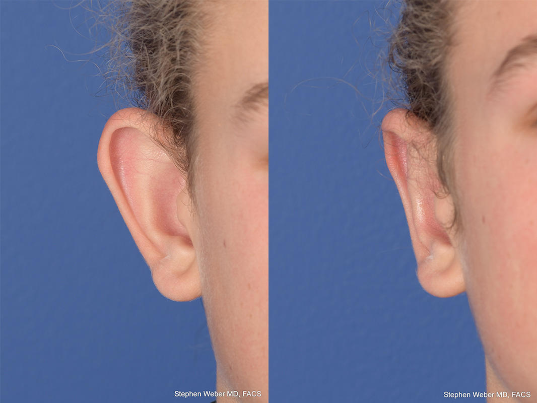 Otoplasty Before and After | Weber Facial Plastic Surgery