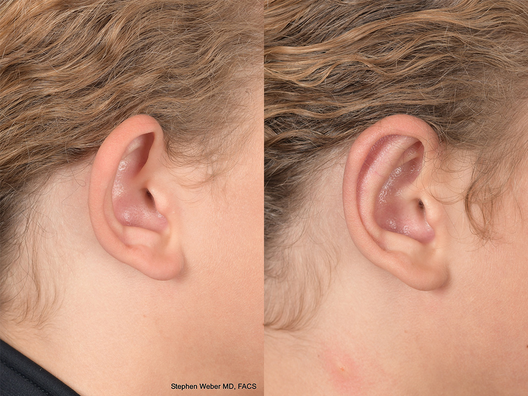 Otoplasty Before and After | Weber Facial Plastic Surgery