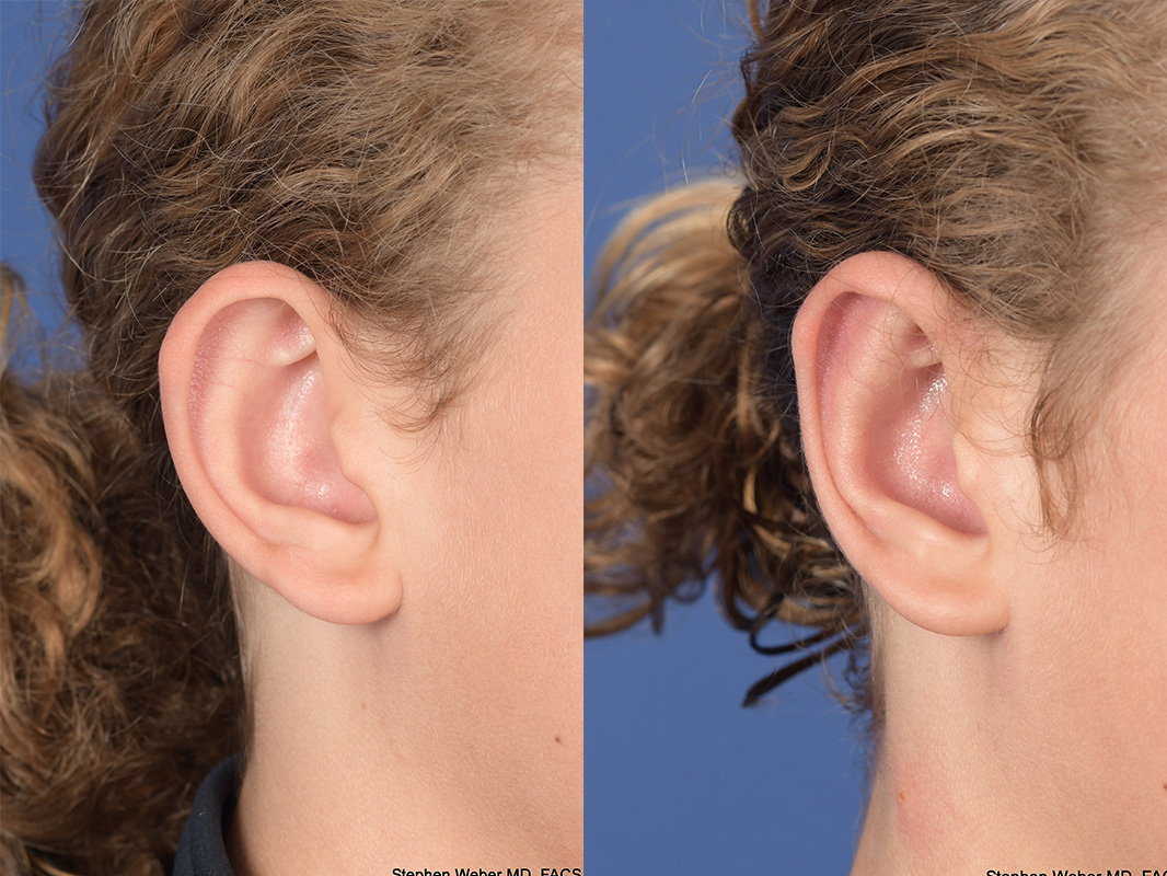 Otoplasty Before and After | Weber Facial Plastic Surgery