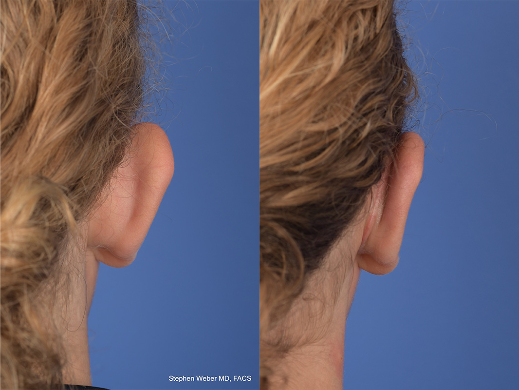 Otoplasty Before and After | Weber Facial Plastic Surgery