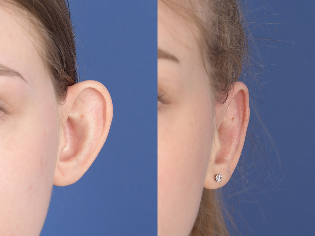 Otoplasty Before and After | Weber Facial Plastic Surgery