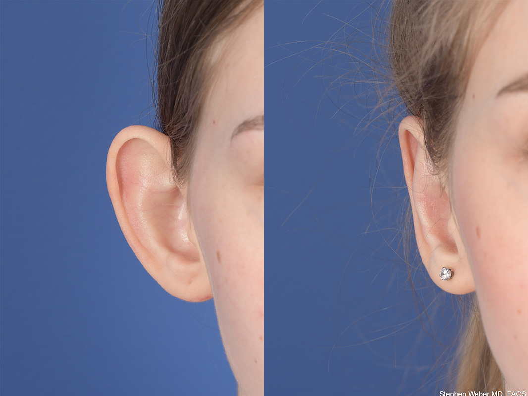 Otoplasty Before and After | Weber Facial Plastic Surgery