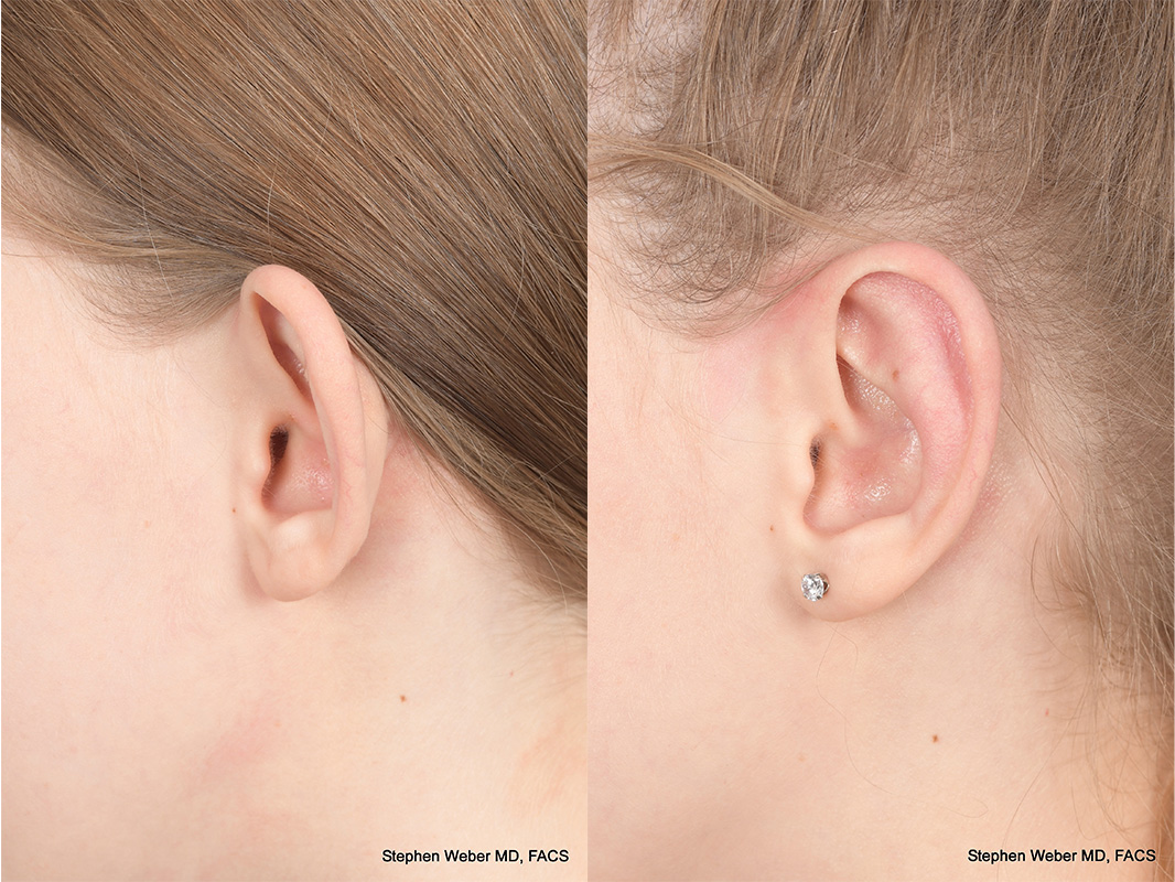 Otoplasty Before and After | Weber Facial Plastic Surgery