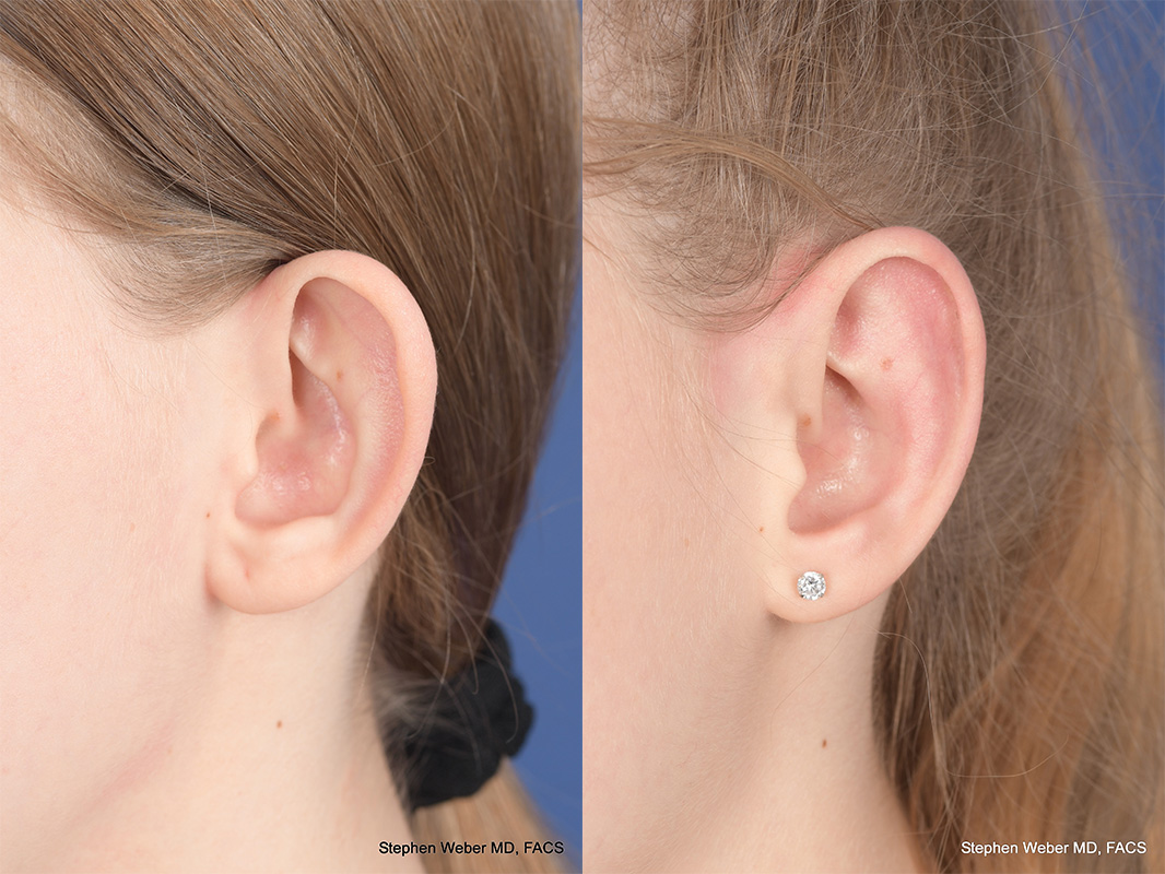 Otoplasty Before and After | Weber Facial Plastic Surgery